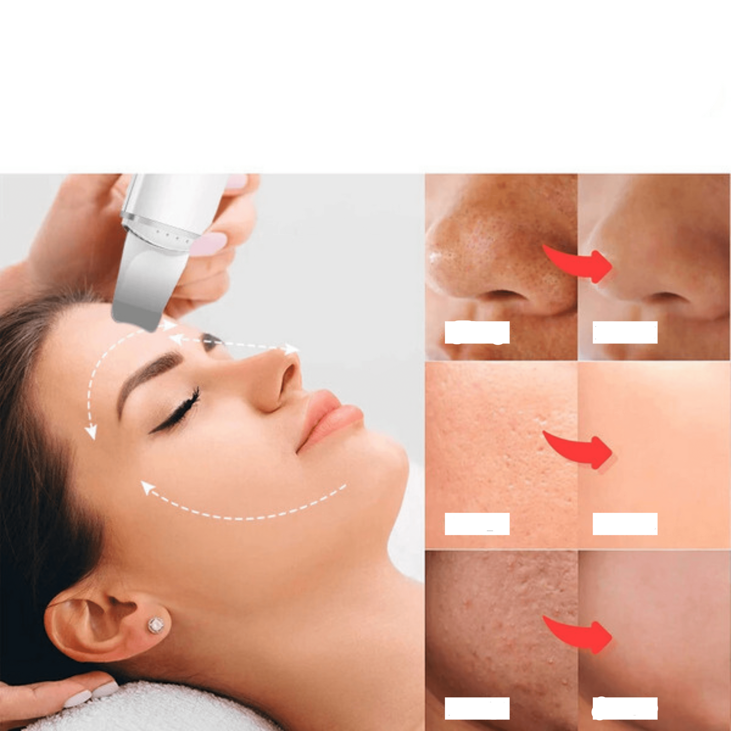 Esfoliador Ultrasónico de Piel: Removedor de Cravos e Limpador Facial com Cavitação 